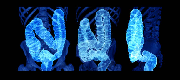 Large bowel or colon Collection of CT colonography  or CT Scan of Colon 3D Rendering image  showing colon for screening colorectal cancer. Check up Screening Colon Cancer. colorectal cancer stock pictures, royalty-free photos & images