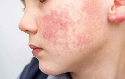 Niño con mejillas rojas, diátesis o síntomas de alergia. Enrojecimiento y descamación de la piel en la cara. photo