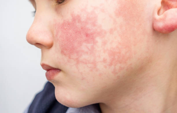 niño con mejillas rojas, diátesis o síntomas de alergia. enrojecimiento y descamación de la piel en la cara. - mejillas enrojecidas fotografías e imágenes de stock