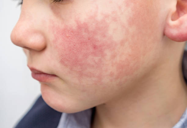 niño con mejillas rojas, diátesis o síntomas de alergia. enrojecimiento y descamación de la piel en la cara. - piel enrojecida fotografías e imágenes de stock