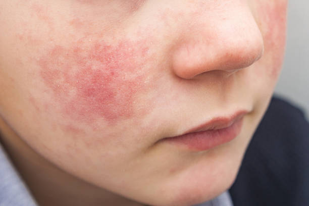 niño con mejillas rojas, diátesis o síntomas de alergia. enrojecimiento y descamación de la piel en la cara. - mejillas enrojecidas fotografías e imágenes de stock