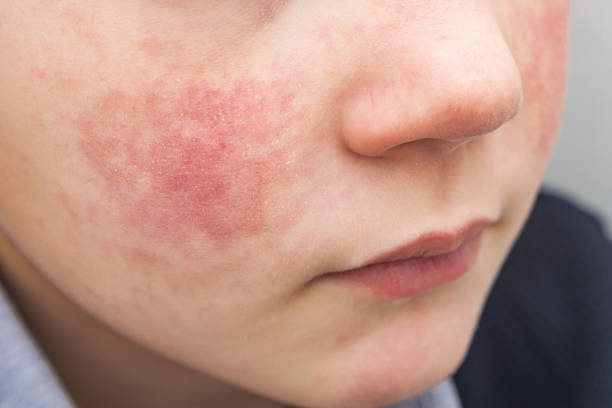 Boy with red cheeks- diathesis or allergy symptoms. Redness and peeling of the skin on the face. Boy with rosy red cheeks- diathesis or allergy symptoms. Redness and peeling of the skin on the face. rosy cheeks stock pictures, royalty-free photos & images