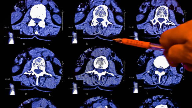 der arzt analysiert die ergebnisse der magnetresonanztomographie einer patientenwirbelsäule mit chronischen rückenschmerzen. das mrt zeigt degenerative veränderungen der wirbelsäule, lendenscheibenherniation und nervenwurzelkompression. - x ray image x ray back low stock-fotos und bilder