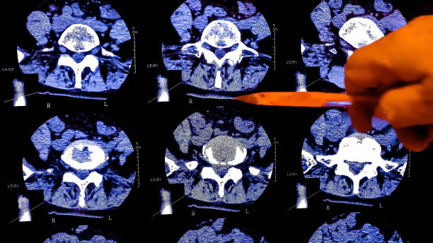 o médico analisa os resultados da ressonância magnética de uma coluna vertebral do paciente com dor crônica nas costas. a ressonância mostra alterações degenerativas de colunas, hérnia de disco lombar e compressão das raízes nervosas. - x ray image x ray back low - fotografias e filmes do acervo