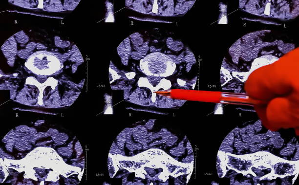 der arzt analysiert die ergebnisse der magnetresonanztomographie einer patientenwirbelsäule mit chronischen rückenschmerzen. das mrt zeigt degenerative veränderungen der wirbelsäule, lendenscheibenherniation und nervenwurzelkompression. - x ray image x ray back low stock-fotos und bilder