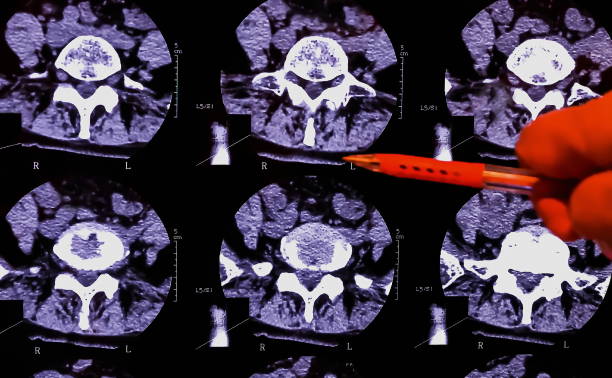 o médico analisa os resultados da ressonância magnética de uma coluna vertebral do paciente com dor crônica nas costas. a ressonância mostra alterações degenerativas de colunas, hérnia de disco lombar e compressão das raízes nervosas. - x ray image x ray back low - fotografias e filmes do acervo