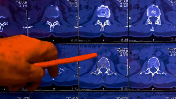 médico analisa os resultados da tomografia computadorizada ou tomografia computadorizada da coluna vertebral do paciente com dor crônica nas costas, mostra alterações degenerativas de colunas, hérnia de disco lombar e compressão de raízes nervosas - x ray image x ray back low - fotografias e filmes do acervo