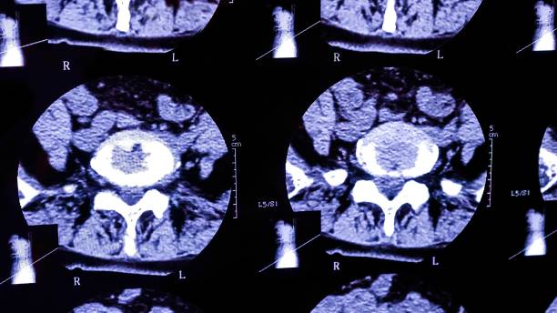 ergebnisse der magnetresonanztomographie einer patientenwirbelsäule mit chronischen rückenschmerzen. das mrt zeigt degenerative veränderungen der wirbelsäule, lendenscheibenherniation und nervenwurzelkompression. - x ray image x ray back low stock-fotos und bilder