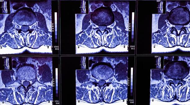 ressonância magnética de uma coluna do paciente com dor crônica nas costas. a ressonância mostra alterações degenerativas de colunas, hérnia de disco lombar e compressão das raízes nervosas.. - x ray image x ray back low - fotografias e filmes do acervo