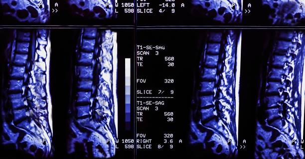 resultados da ressonância magnética de uma coluna vertebral do paciente com dor crônica nas costas. a ressonância mostra alterações degenerativas de colunas, hérnia de disco lombar e compressão das raízes nervosas. - x ray image x ray back low - fotografias e filmes do acervo
