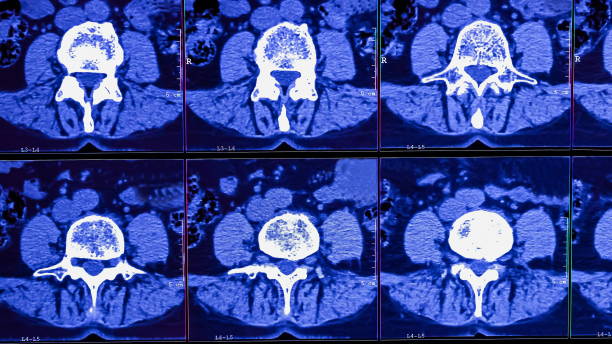 의사는 만성 허리 통증 환자의 인간 척추의 컴퓨터 단층 촬영의 결과를 분석, 척추의 퇴행성 변화를 보여줍니다, 요추 추간판 탈장 및 신경 뿌리 압축 - x ray image x ray back low 뉴스 사진 이미지