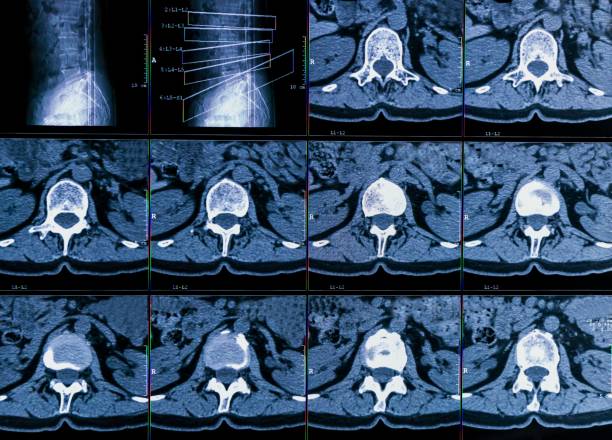 만성 허리 통증 환자의 컴퓨터 단층 촬영 또는 ct 이미징의 결과, 척추의 퇴행성 변화를 보여줍니다, 요추 추간판 ��탈장 및 신경 뿌리 압축 - x ray image x ray back low 뉴스 사진 이미지