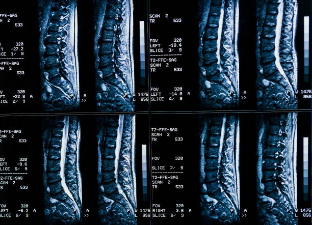 Magnetic resonance imaging of a patient spine with chronic back pain. The MRI shows degenerative changes of spines, lumbar discs herniation and nerve roots compression. stock photo