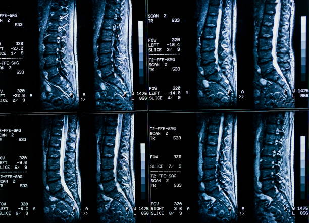 ressonância magnética de uma coluna do paciente com dor crônica nas costas. a ressonância mostra alterações degenerativas de colunas, hérnia de disco lombar e compressão das raízes nervosas. - x ray image x ray back low - fotografias e filmes do acervo