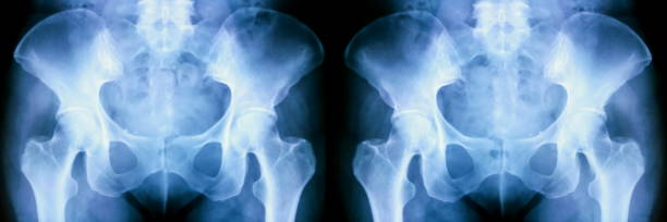 sada rentgenu lidských pánevních kostí - gangréna - stock snímky, obrázky a fotky