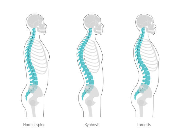 Kyphosis, lordosis flat vector illustration. Spinal deformity flat vector illustration. Kyphosis, lordosis of spine infographics. Diagram with spine curvatures and healthy backbone. Body posture defect. Medical, educational and science banner kyphosis stock illustrations