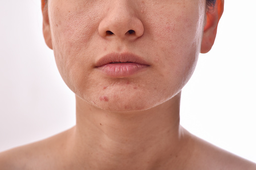 Problema de la piel con enfermedades del acné, Cara de mujer de cerca con granos de cabeza blanca, cicatriz y cara grasa grasa, concepto de belleza. photo