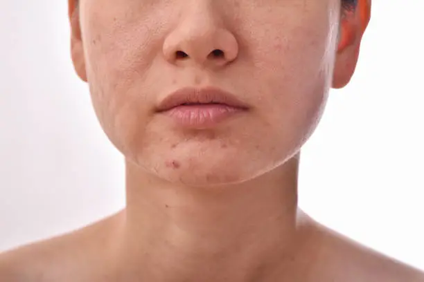 Skin problem with acne diseases, Close up woman face with whitehead pimples, Scar and oily greasy face, Beauty concept.