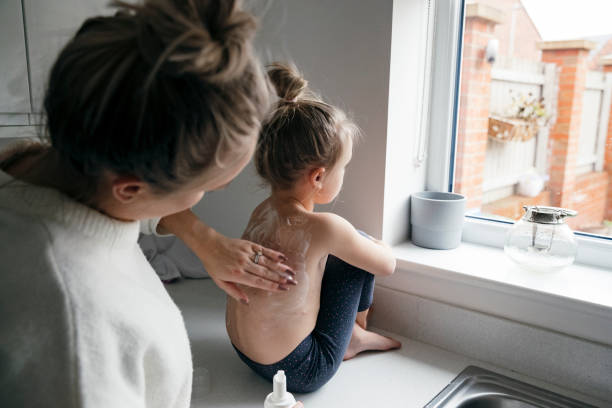 A Little Bit More Female Caucasian child with chicken pox sat on the kitchen counter with her bare back to her mum as she gently rubs cooling cream on to her skin. half dressed girls pictures stock pictures, royalty-free photos & images