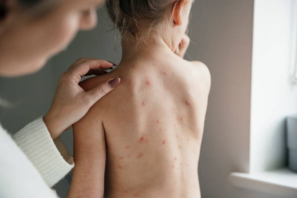 Let Mammy Check Female Caucasian child with chicken pox sat with her bare back to the camera, as her mum looks at the spots on her skin. half dressed girls pictures stock pictures, royalty-free photos & images
