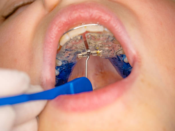 Doctor setting  with tool of palatal brace stock photo