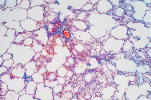 istock Human lung tissue under microscope, The lungs is organs of the respiratory system in humans. Human pathology education. 1214253196