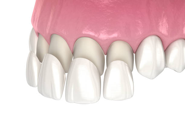 procedimiento de instalación de chapa sobre incisivo central e incisivo lateral. ilustración 3d dental médicamente precisa - porcelana fotografías e imágenes de stock