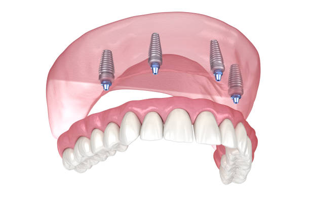 maxillary prosthesis with gum all on 4 system supported by implants. medically accurate 3d illustration of human teeth and dentures - implantat imagens e fotografias de stock