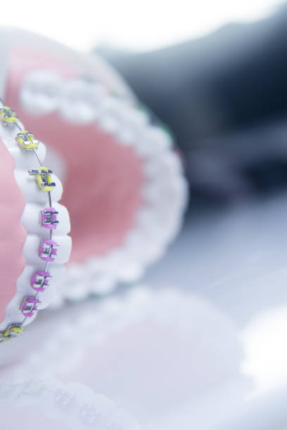 istock Model denture with metal orthodontics. No people 1214566388
