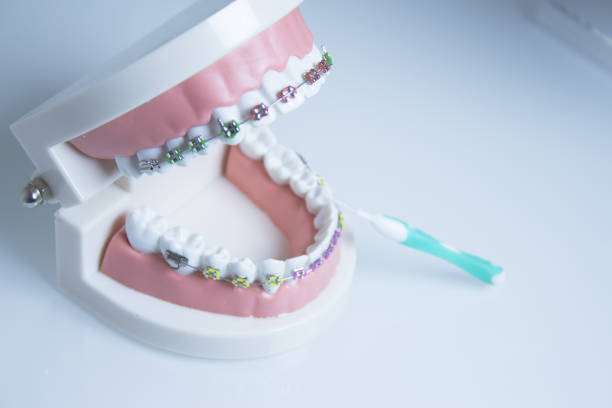 istock Model denture with metal orthodontics. No people 1214566461