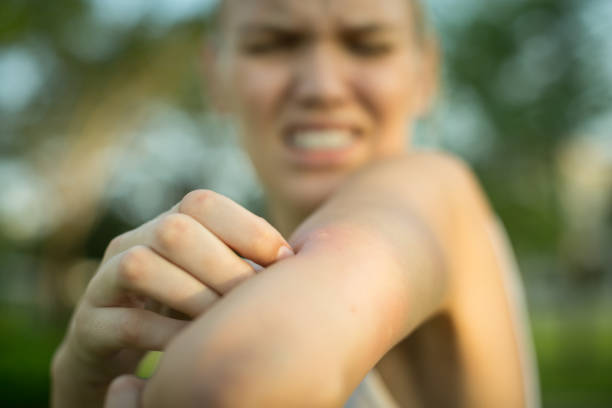 A woman scratching her itchy mosquito bite. Tropical climate danger. close up of a red mosquito bite on a person's arm, rubbing and scratching it outdoor in the park. mosquito stock pictures, royalty-free photos & images