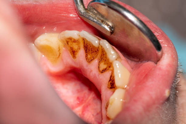 istock poor dental hygiene. Plaque on teeth after smoking cigarettes and not observing toothbrushing 1214617887