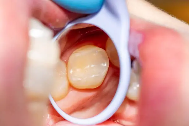 close-up treatment of a human tooth using blue rabberdam system and a dental mirror. Aesthetic dentistry, hygiene