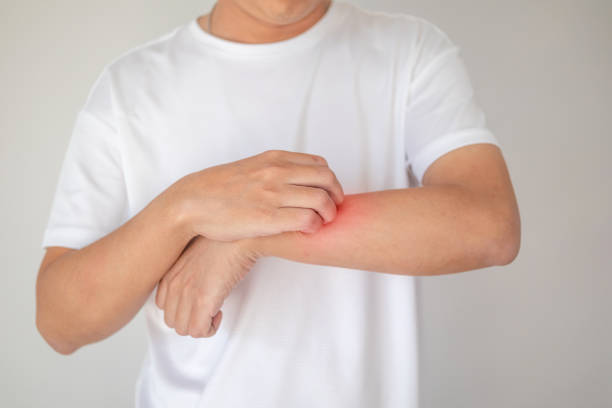 istock man itching and scratching on arm from itchy dry skin eczema dermatitis 1214627178
