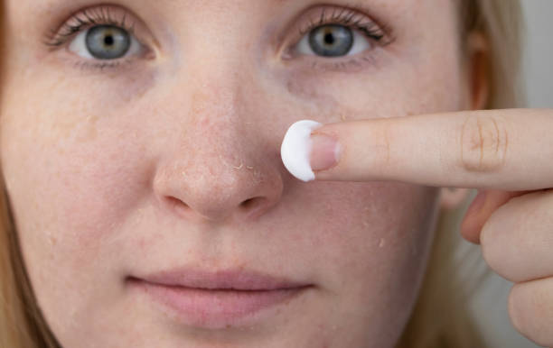 una mujer examina la piel seca en su rostro. pelar, engrosamiento, molestias, sensibilidad a la piel. paciente en la cita de un dermatólogo o cosmetólogo, selección de crema para la sequedad - seco fotografías e imágenes de stock