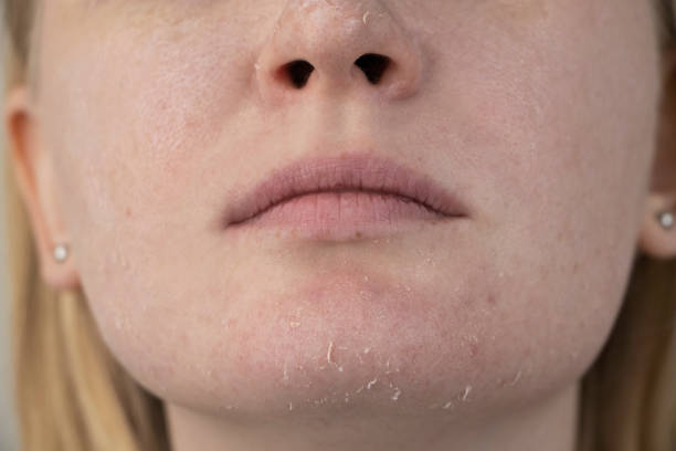 A woman examines dry skin on her face. Peeling, coarsening, discomfort, skin sensitivity. Patient at the appointment of a dermatologist or cosmetologist, selection of cream for dryness stock photo
