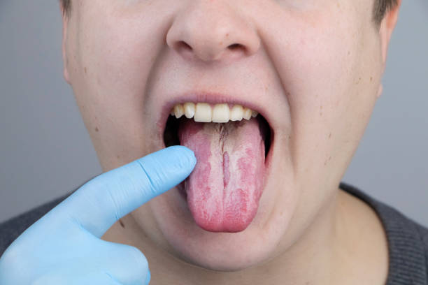 weißer quark auf der zunge. ein arzt oder gastroenterologe untersucht die zunge eines mannes. patient hat schlechte mundhygiene oder ein symptom einer krankheit - gastroenterologe stock-fotos und bilder