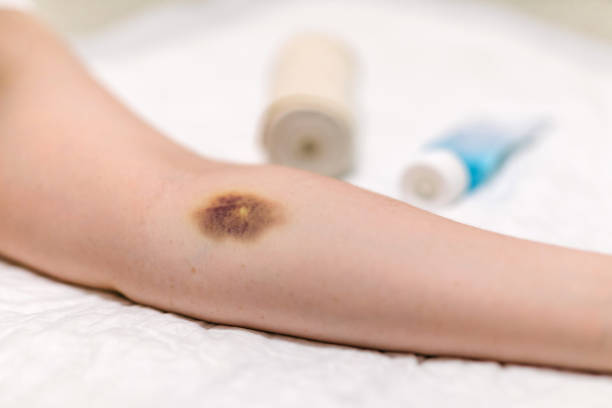 istock First aid for bruising. Large hematoma bruise on the arm and bandage 1214640492