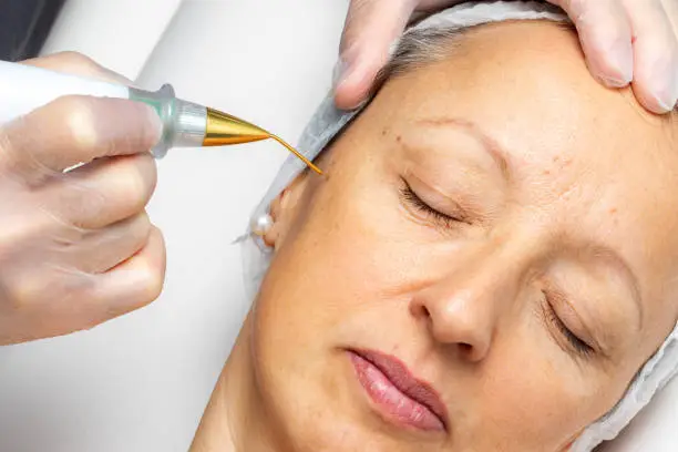 Photo of Top view of laser plasma pen removing facial wart on middle aged woman.