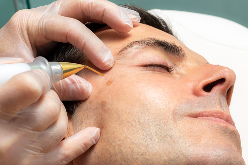Macro primer plano de la pluma de plasma láser eliminando el melanoma facial en el hombre de mediana edad. photo