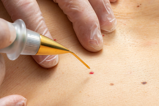 Macro primer plano de la pluma de plasma láser eliminando angioma de cereza en la piel humana. photo