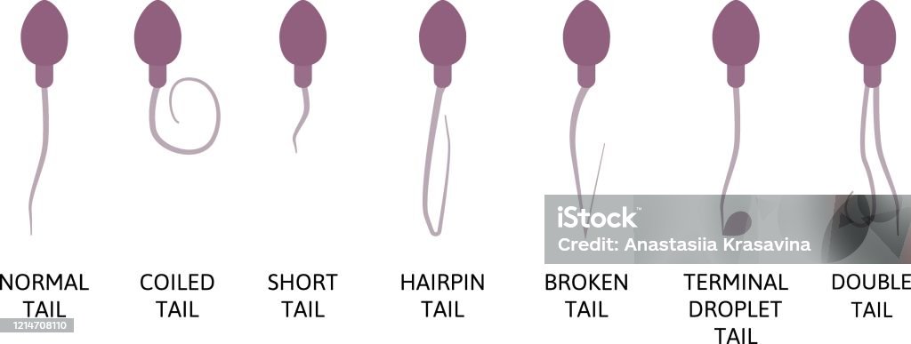сперма на голове Параметры Спермограммы И Спермы Тератозооспермия Нормальная И Ненормальная Сперма  Голова Дефектов Сперматозоидов — стоковая векторная графика и другие  изображения на тему Сперма - iStock