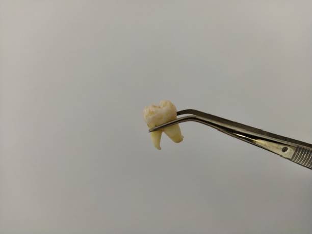 istock Removed tooth in tweezers on a white background 1214709632