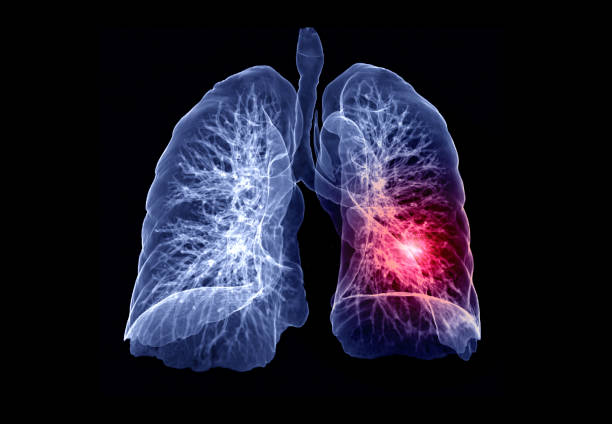 ct-lunge 3d-renderingbild - illness x ray image chest x ray stock-fotos und bilder