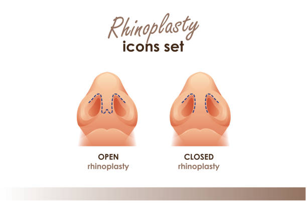 ринопластика. открытая и закрытая ринопластика. вид снизу. пластическая хирургия носа. медицинская и красота иллюстрация - nose job illustrations stock illustrations