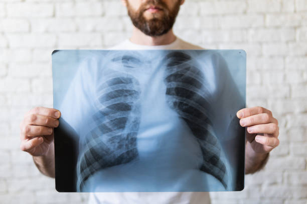 Young bearded man holding X-ray film of lungs in front of his chest stock photo