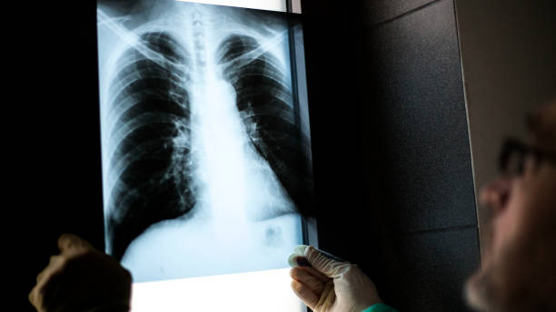 istock Roentgen shot of lungs 1214742933