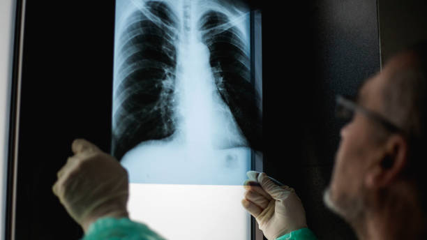 istock Roentgen shot of lungs 1214744110