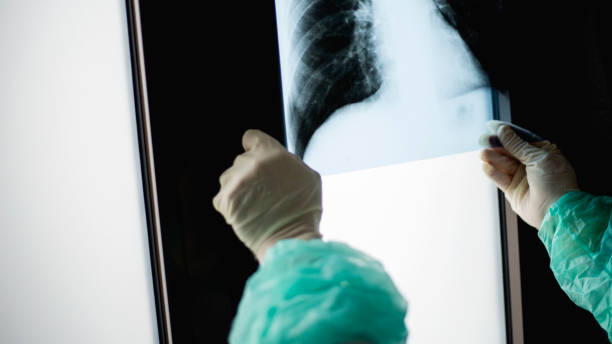 istock Roentgen shot of lungs 1214745601