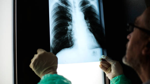 istock Roentgen shot of lungs 1214745740